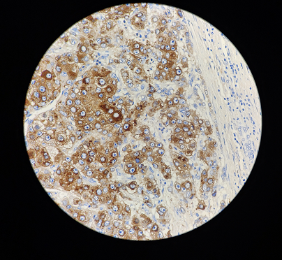 AFP(甲胎蛋白)抗体免疫组织化学染色，强度3+