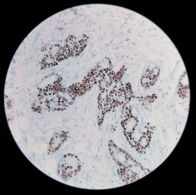 Progesterone Receptor 重组兔单克隆抗体免疫组织化学染色(乳腺癌)