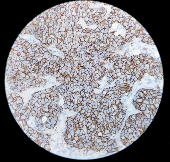 HER2 重组兔单克隆抗体免疫组织化学染色（乳腺癌）