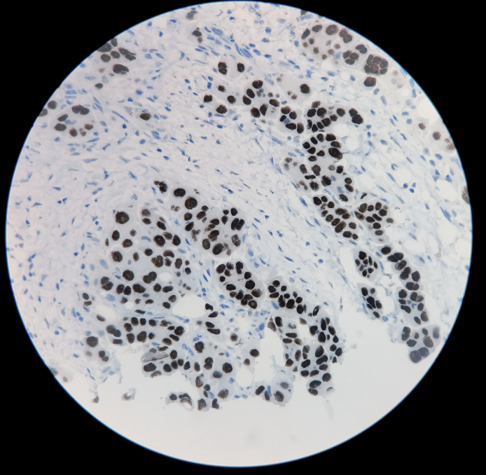 TTF-1 重组兔单克隆抗体免疫组织化学染色（肺腺癌）
