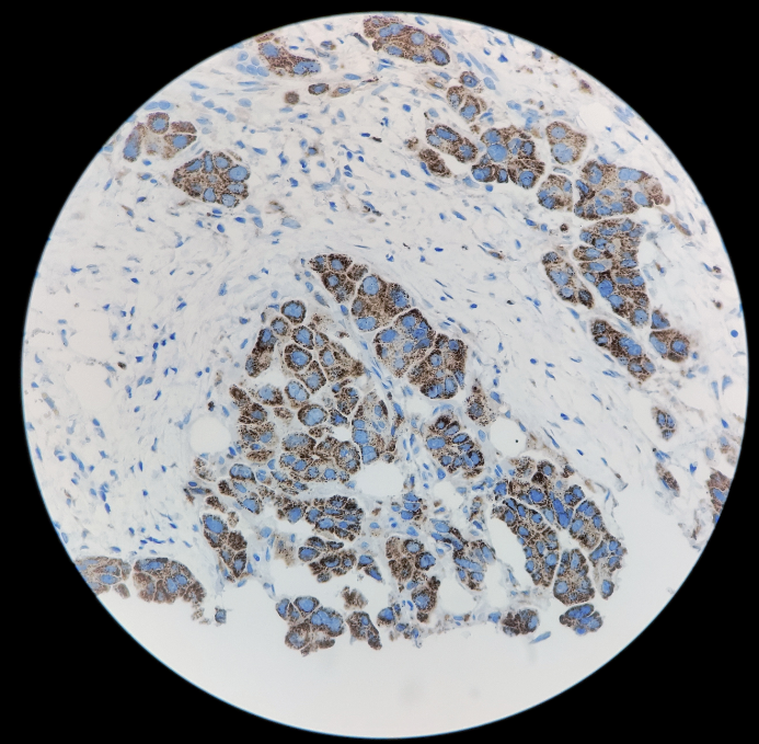 Napsin A 重组兔单克隆抗体免疫组织化学染色（肺腺癌）